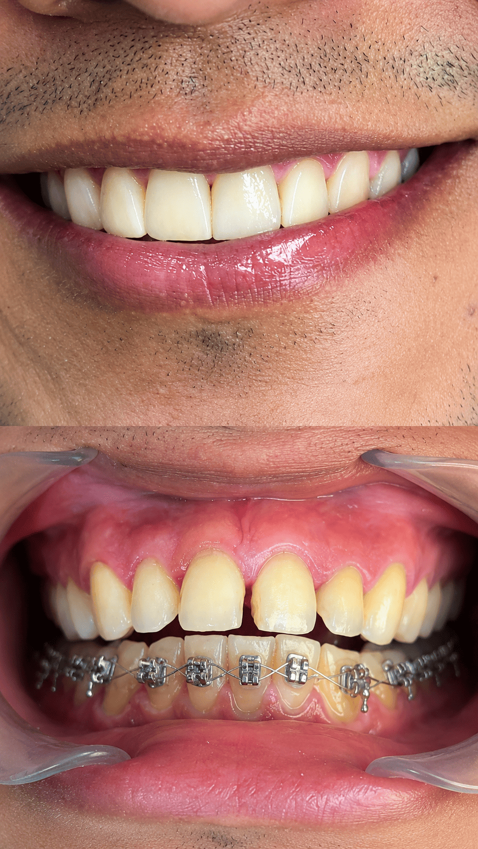 Antes y después - caso de restauración dental