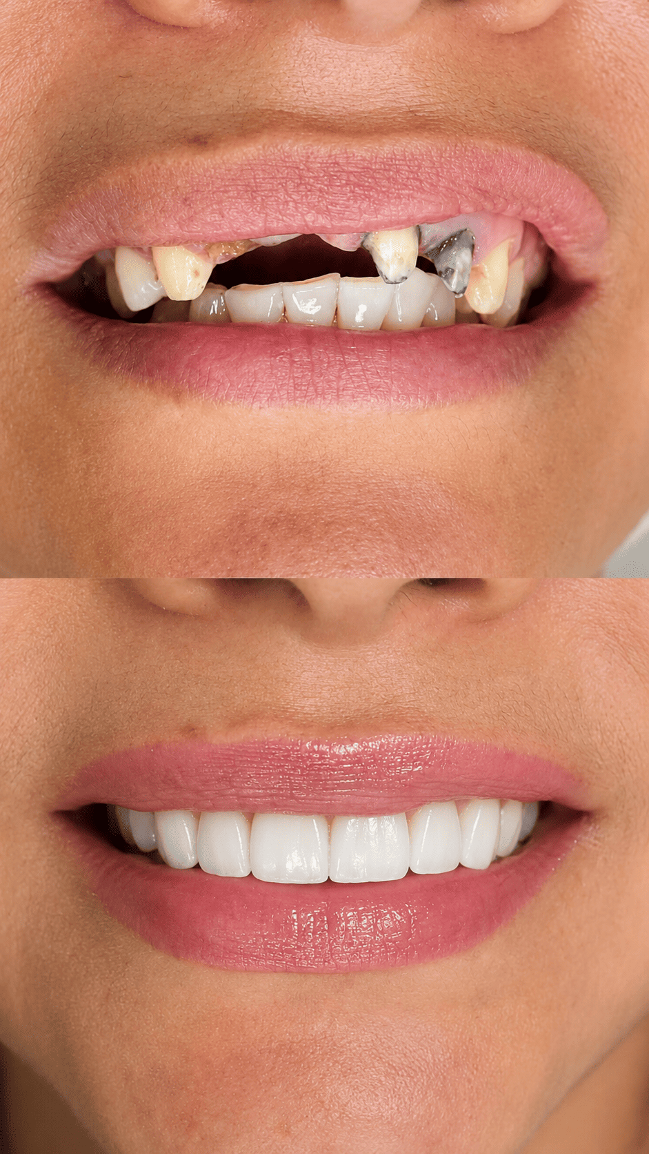Antes y después - caso de restauración dental