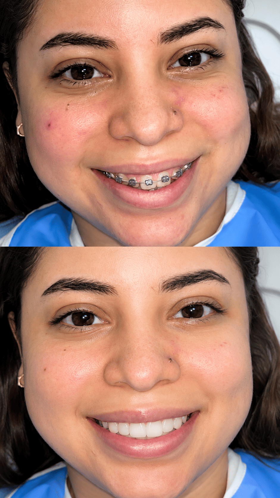 Antes y después - caso de restauración dental