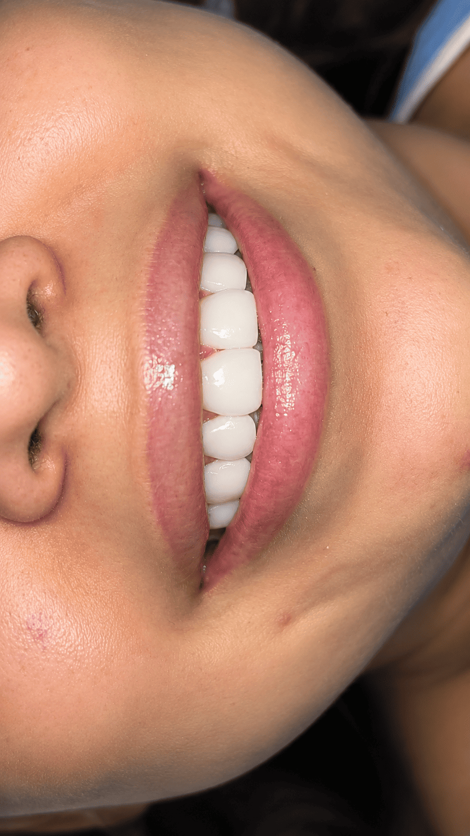 Antes y después - caso de restauración dental